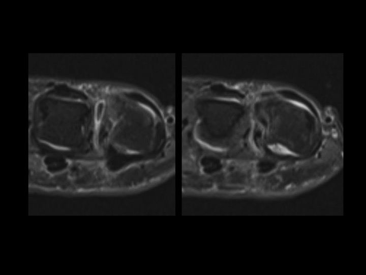Figure 3 for case radial collateral ligament of metacarpophalangeal joint ( RID2335 )